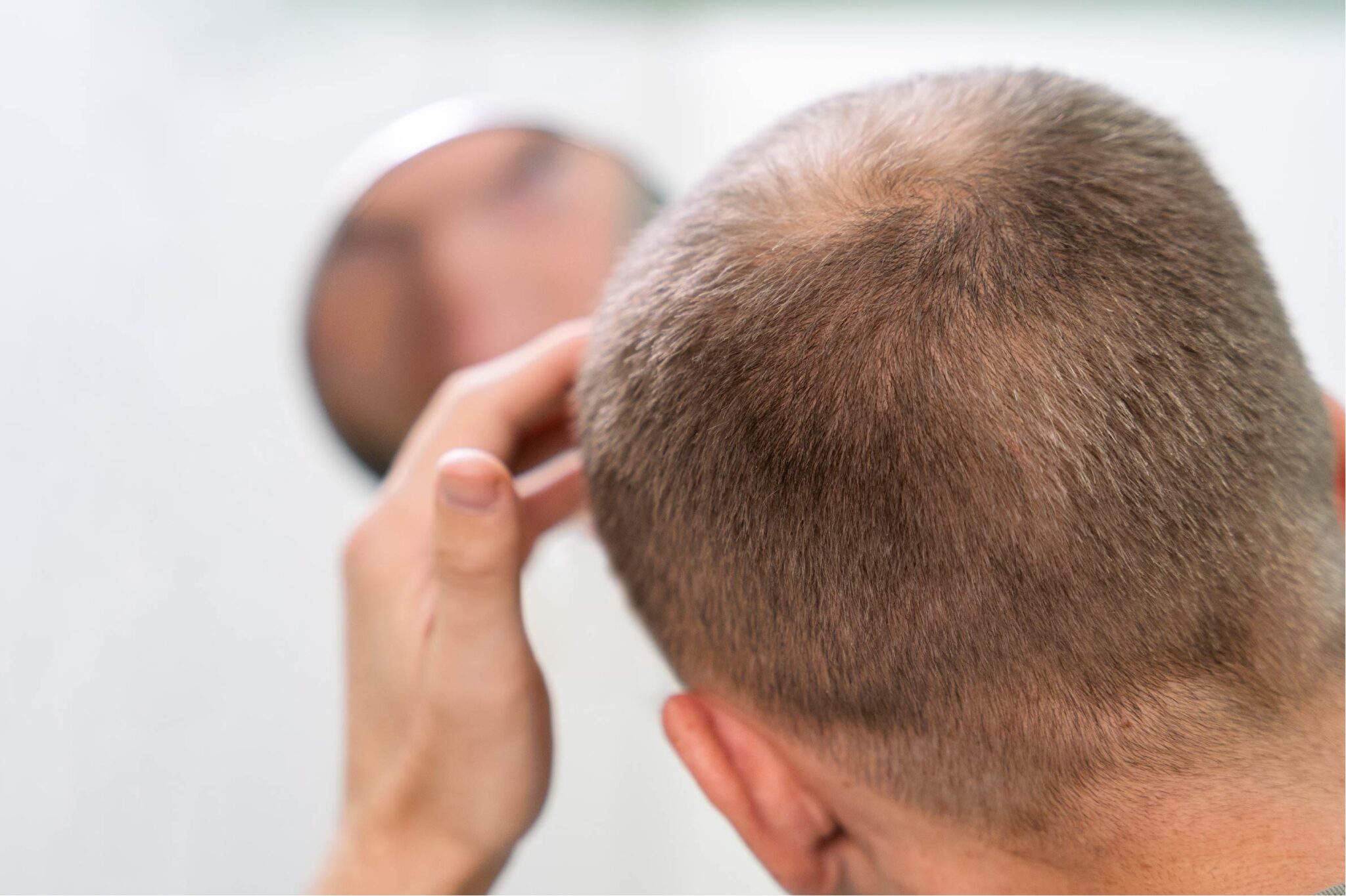 Combatiendo la Alopecia Masculina: Causas y Soluciones