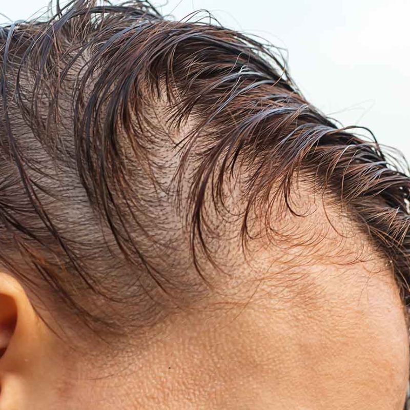 Tipos de Alopecia Masculina