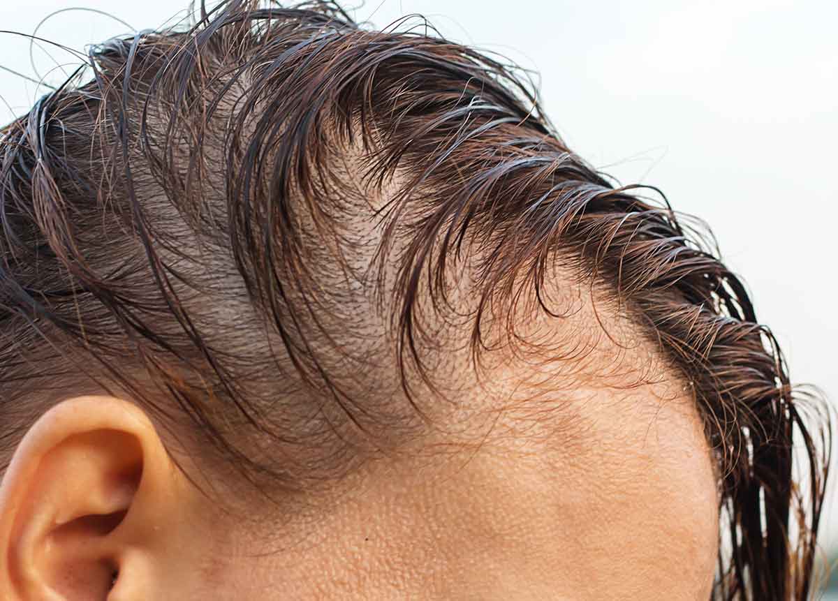 Tipos de Alopecia Masculina y Estrategias de Tratamiento Efectivas