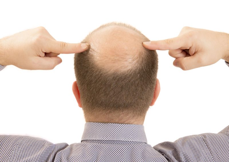 preoperatorio Implante de Pelo en Valencia