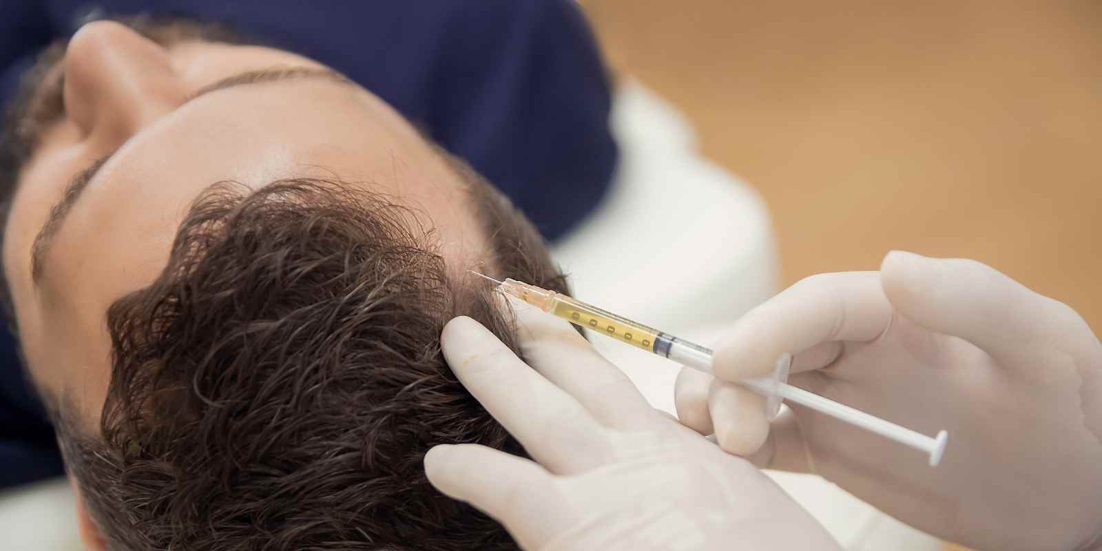 Mesoterapia en Valencia: Recupera la Salud y Belleza de tu Cabello en Clínica Salud Capilar