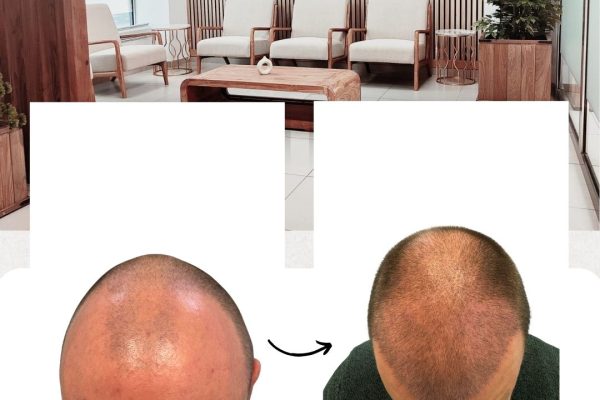 casos-reales-trasplante-de-pelo (1)