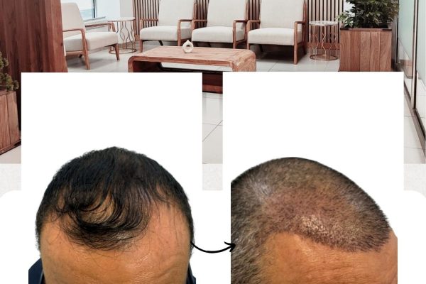 casos-reales-trasplante-de-pelo (3)
