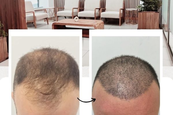 casos-reales-trasplante-de-pelo (4)