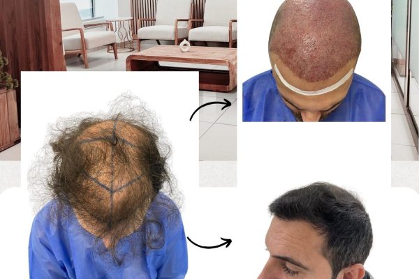 casos-reales-trasplante-de-pelo (7)