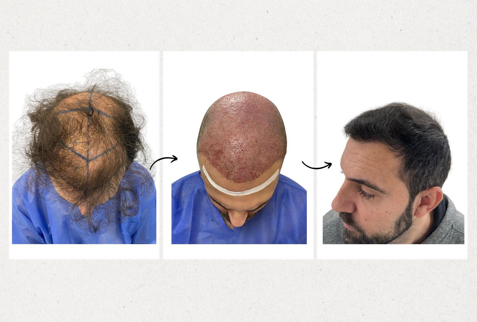 ¿Por qué elegir una clínica de injerto capilar en Valencia en lugar de Turquía? Descubre las razones con Clínica Salud Capilar