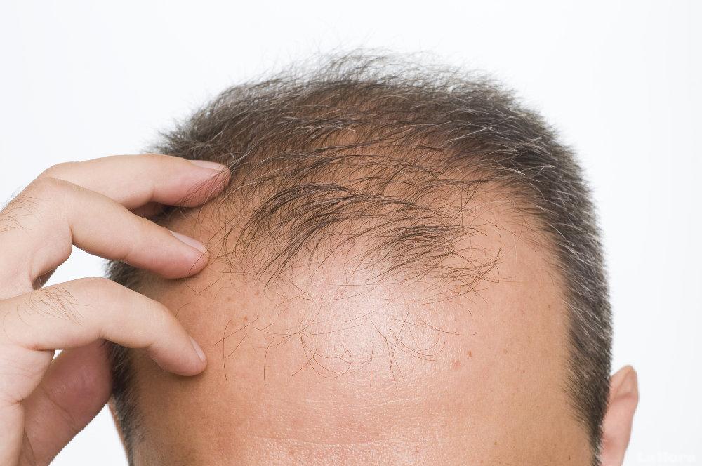 Cuáles son los Tipos de Alopecia Masculina