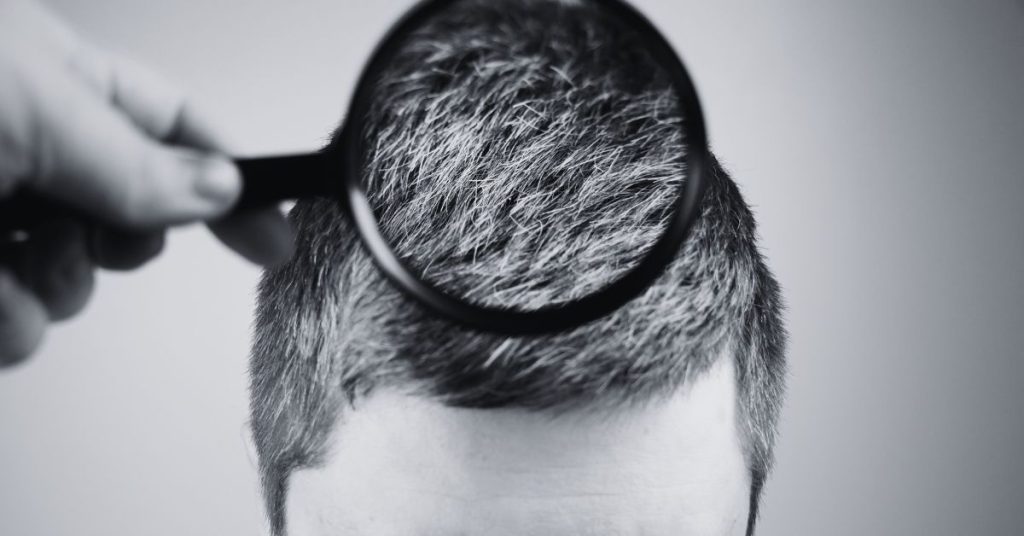 ¿Cuánto tarda en crecer el pelo después de un implante capilar?