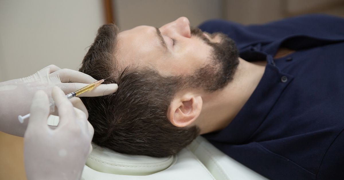 Mesoterapia capilar en hombres en Valencia: Una solución innovadora para la pérdida de cabello