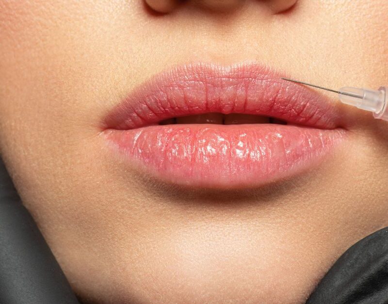 Aumento de labios con ácido hialurónico en Valencia