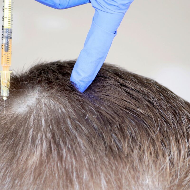 Dutasteride aplicado a la caída del cabello