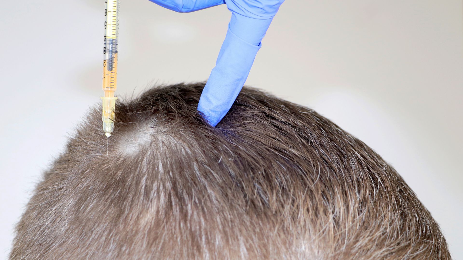 ¿El tratamiento con dutasteride es eficaz contra la caída del pelo?