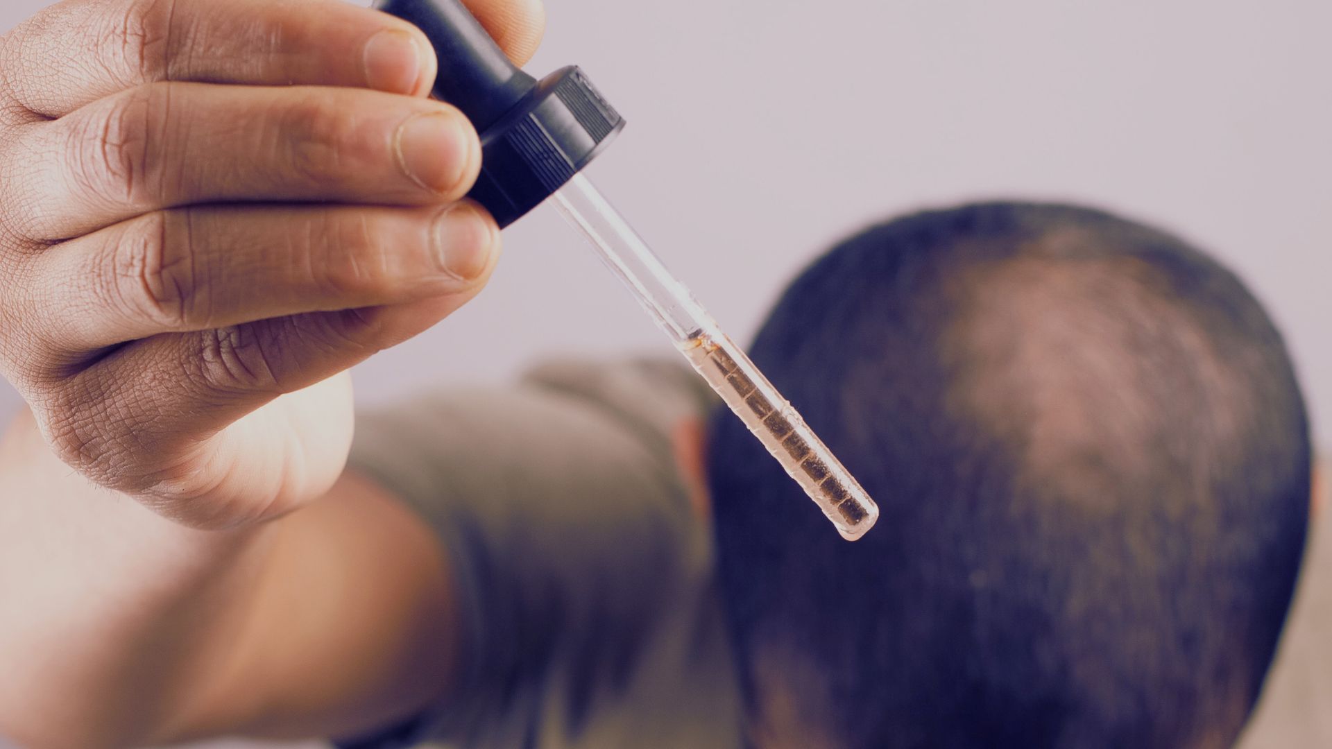 Tratamiento Minoxidil Valencia: El Tratamiento Que Puede Transformar Tu Cabello