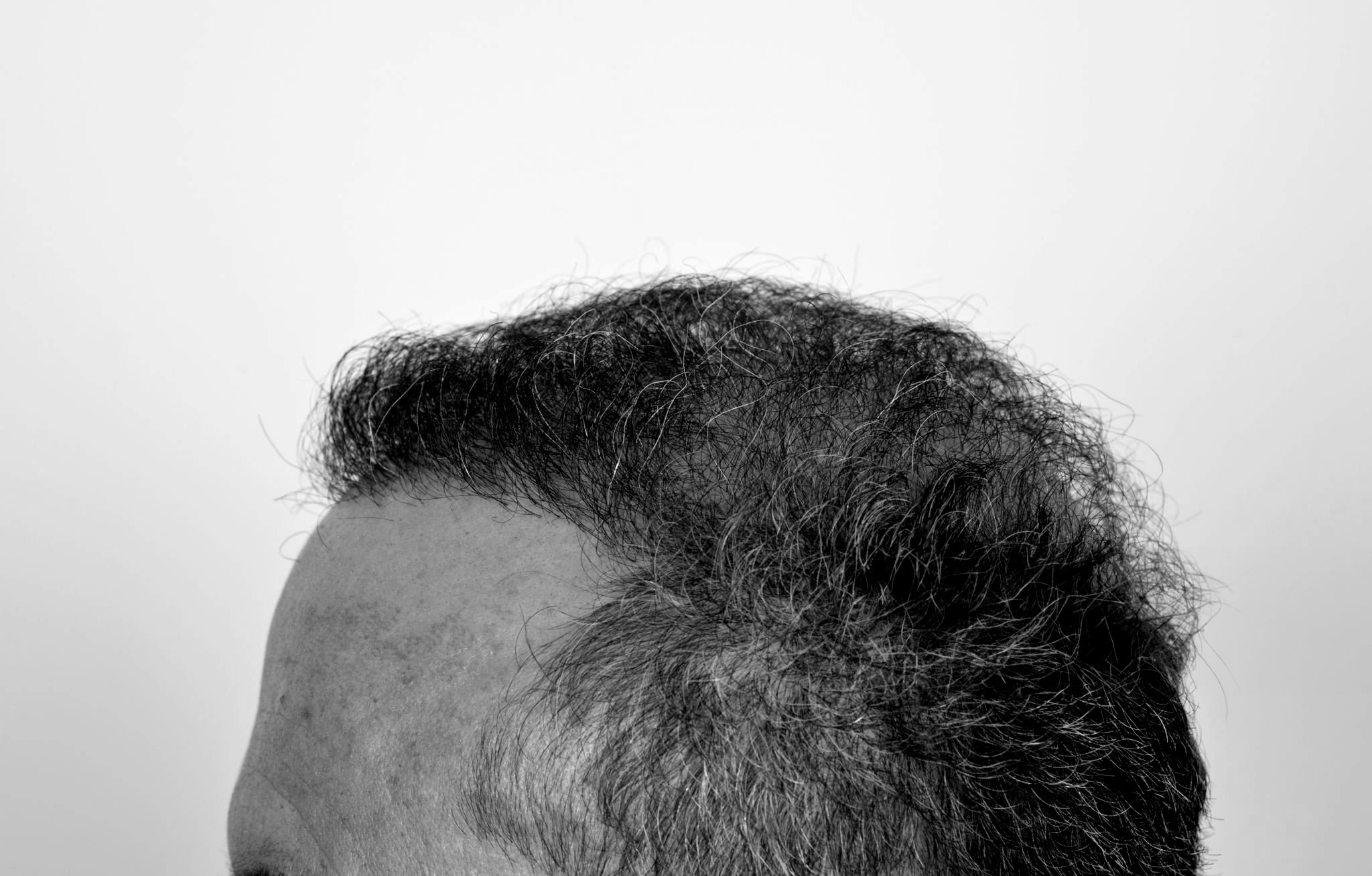 Solucionar un Mal Injerto Capilar: Recupera tu Cabello con Éxito
