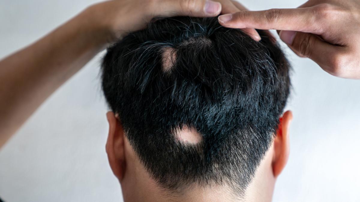 Alopecia Areata: Comprende esta condición y descubre las mejores soluciones en Valencia