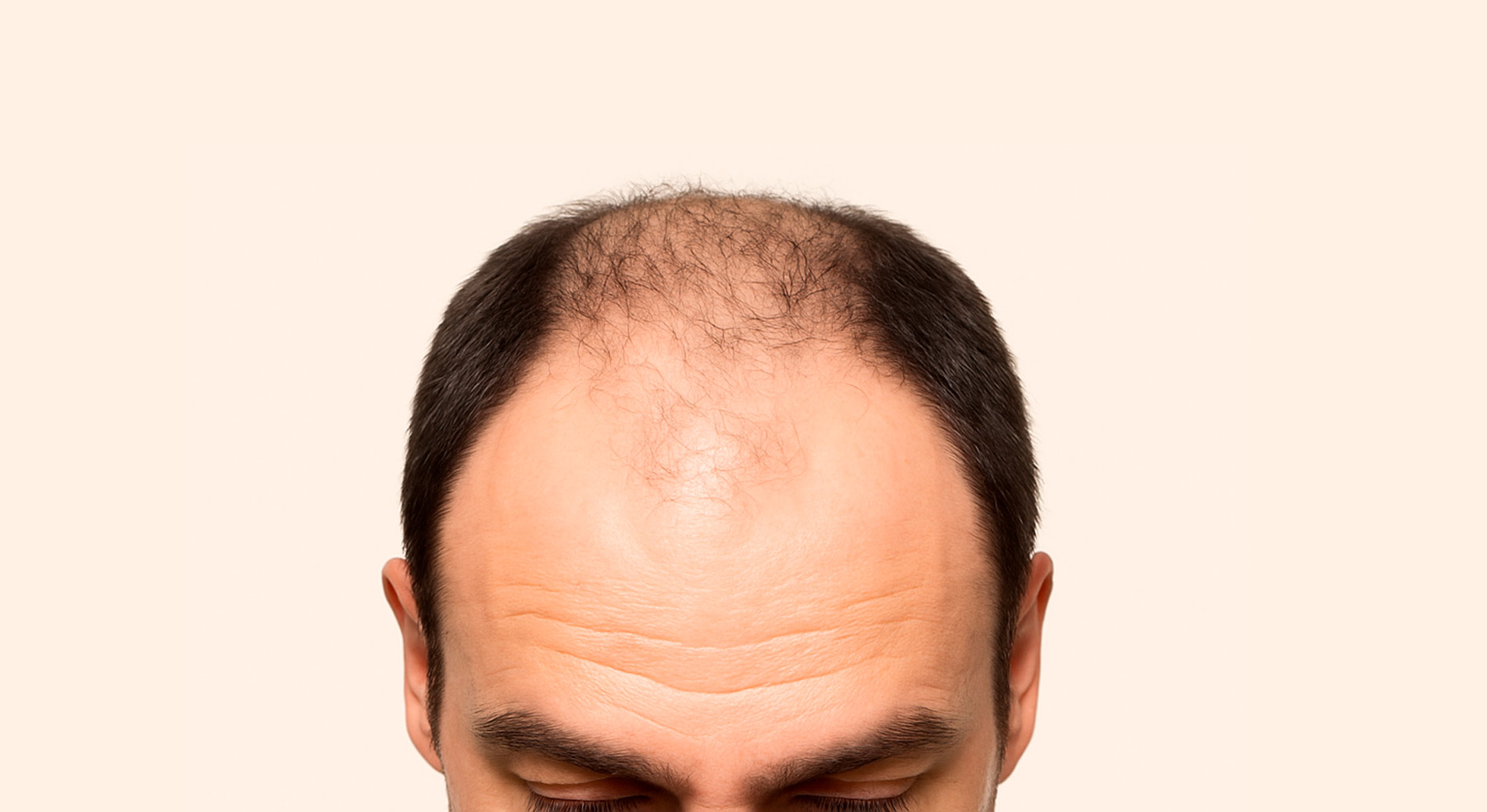 Alopecia una cuestión de salud