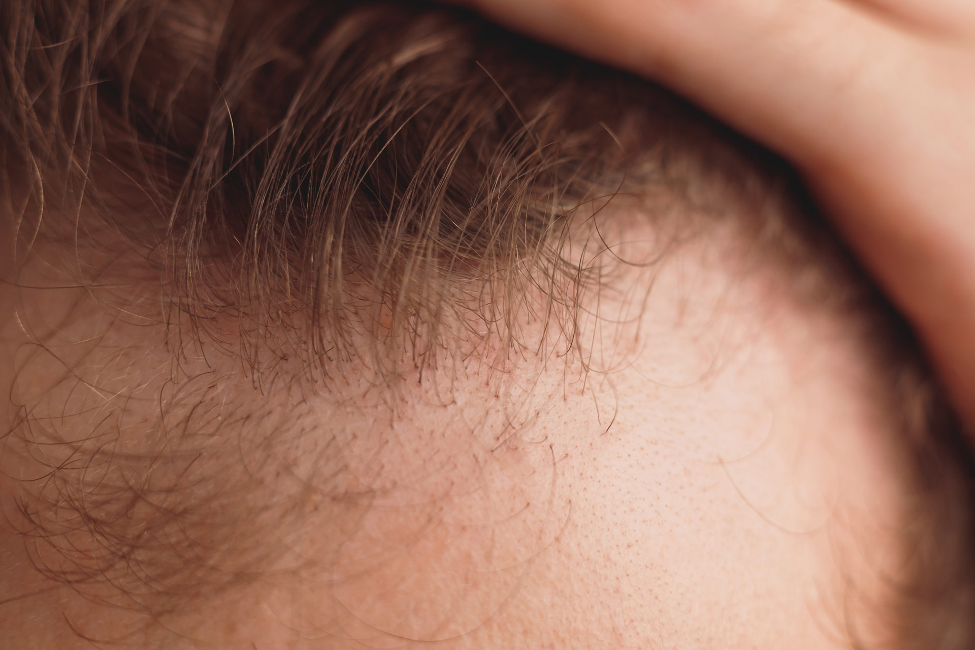 ¿Cuándo empieza a crecer el pelo injertado? Fases reales del trasplante capilar mes a mes