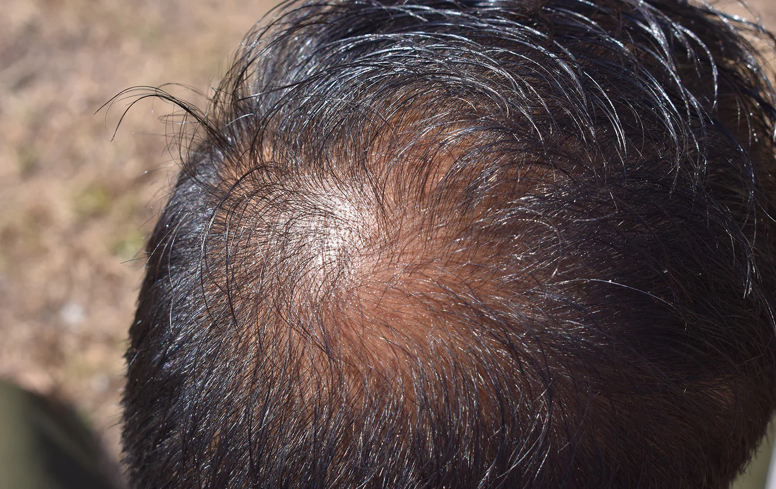 Miniaturización capilar: la señal temprana de la alopecia que casi nadie detecta a tiempo