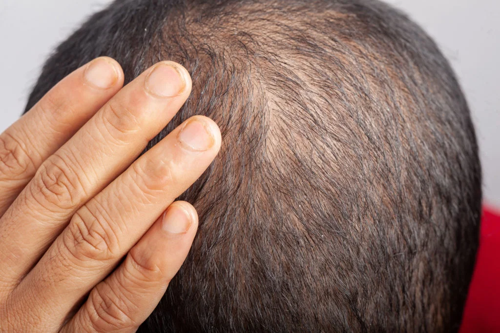 ¿Cómo saber si necesito un injerto capilar o tratamiento médico? La decisión que marcará el futuro de tu cabello